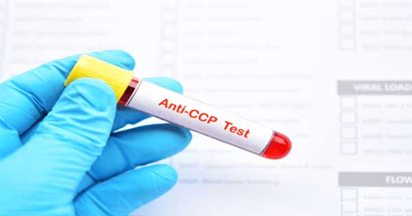 CCP Antibody Test: Uses, Side Effects, Procedure, Results