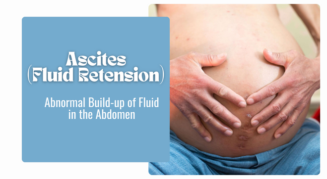 Ascites (Water Retention in Abdomen): Causes, Signs & Treatment