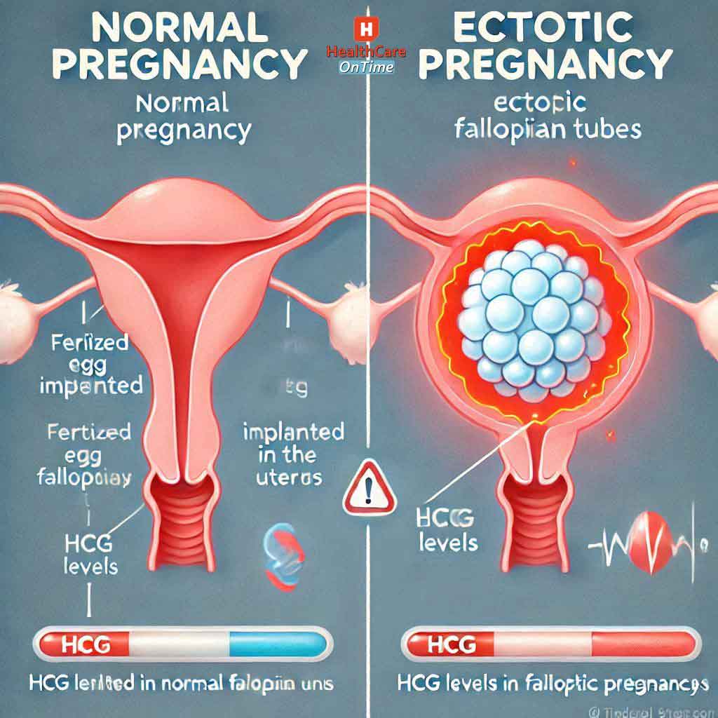 Ectopic Pregnancy HCG Levels Chart infographic