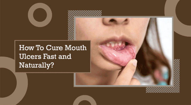 mouth ulcer treatment