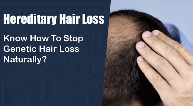 Hereditary Hair Loss: How To Stop Genetic Hair Loss Naturally?