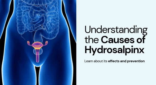 Hydrosalpinx: Causes, Symptoms, Diagnosis, and Treatment