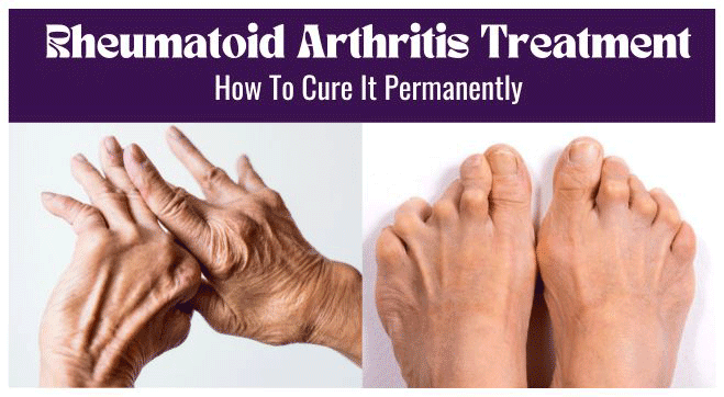 Rheumatoid Arthritis Treatment: How to Cure Rheumatoid Arthritis Permanently