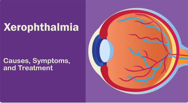 Xerophthalmia: Causes, Symptoms, and Cure